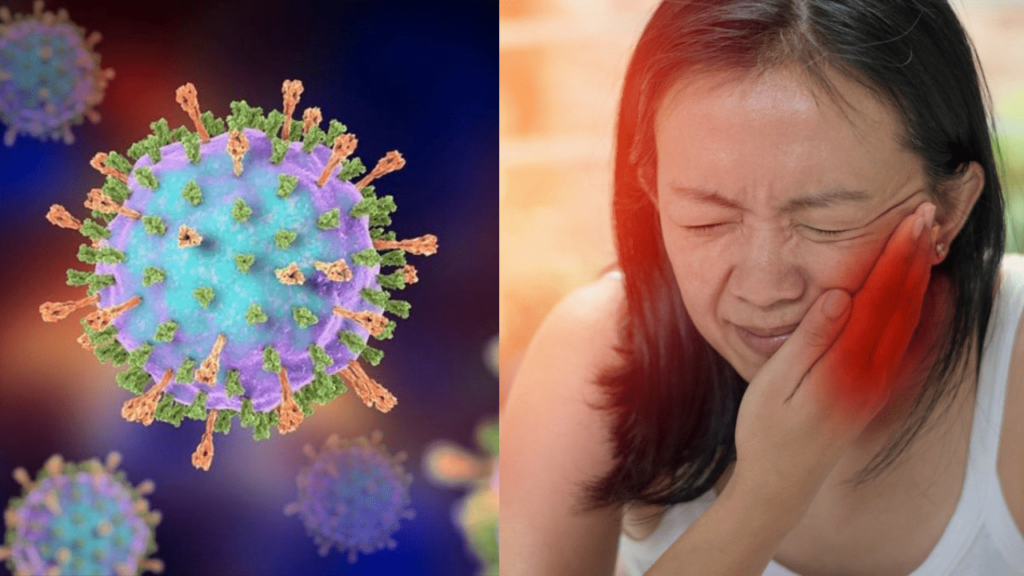 Mumps Virus Outbreak Sweeps Delhi NCR, Intense Spreading Among Children! Mumps Virus