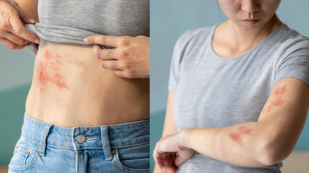 Unraveling the Mystery of Shingles Rash: What Triggers Its Agonizing Emergence? Shingles Rash
