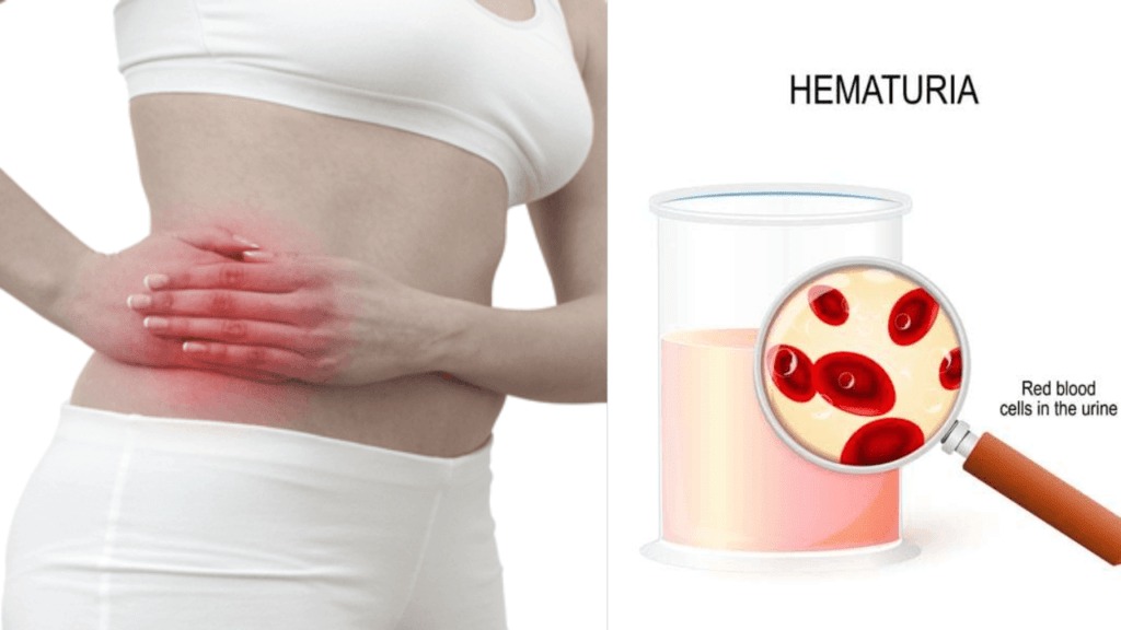 Blood in Urine? Discover Hematuria and it's Causes, Symptoms, and Cures in 2024 Hematuria Explained: What It Means to See Blood in Your Urine