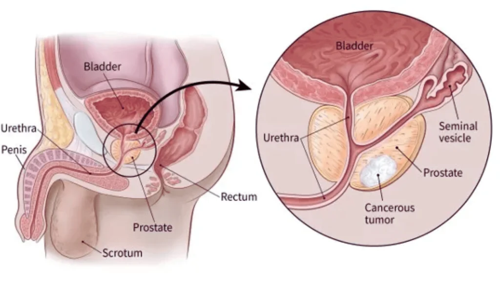 Prostate Cancer: A Detailed Insight into Causes, Symptoms, and Preventive Measures Prostate Cancer: A Detailed Insight into Causes, Symptoms, and Preventive Measures