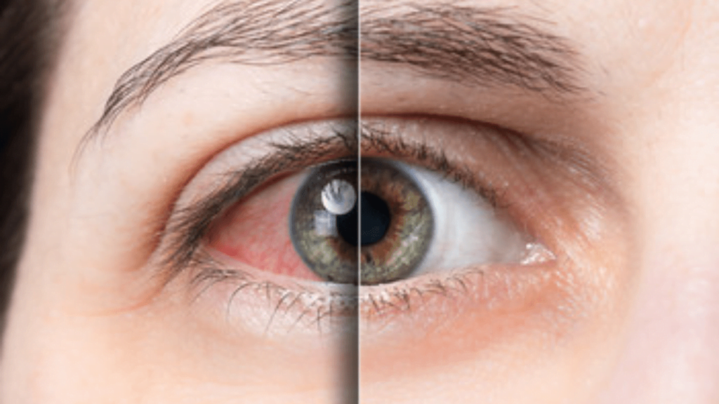 Combatting Dry Eyes: A Comprehensive Guide to Causes and Solutions in 2024 Dry Eye Syndrome