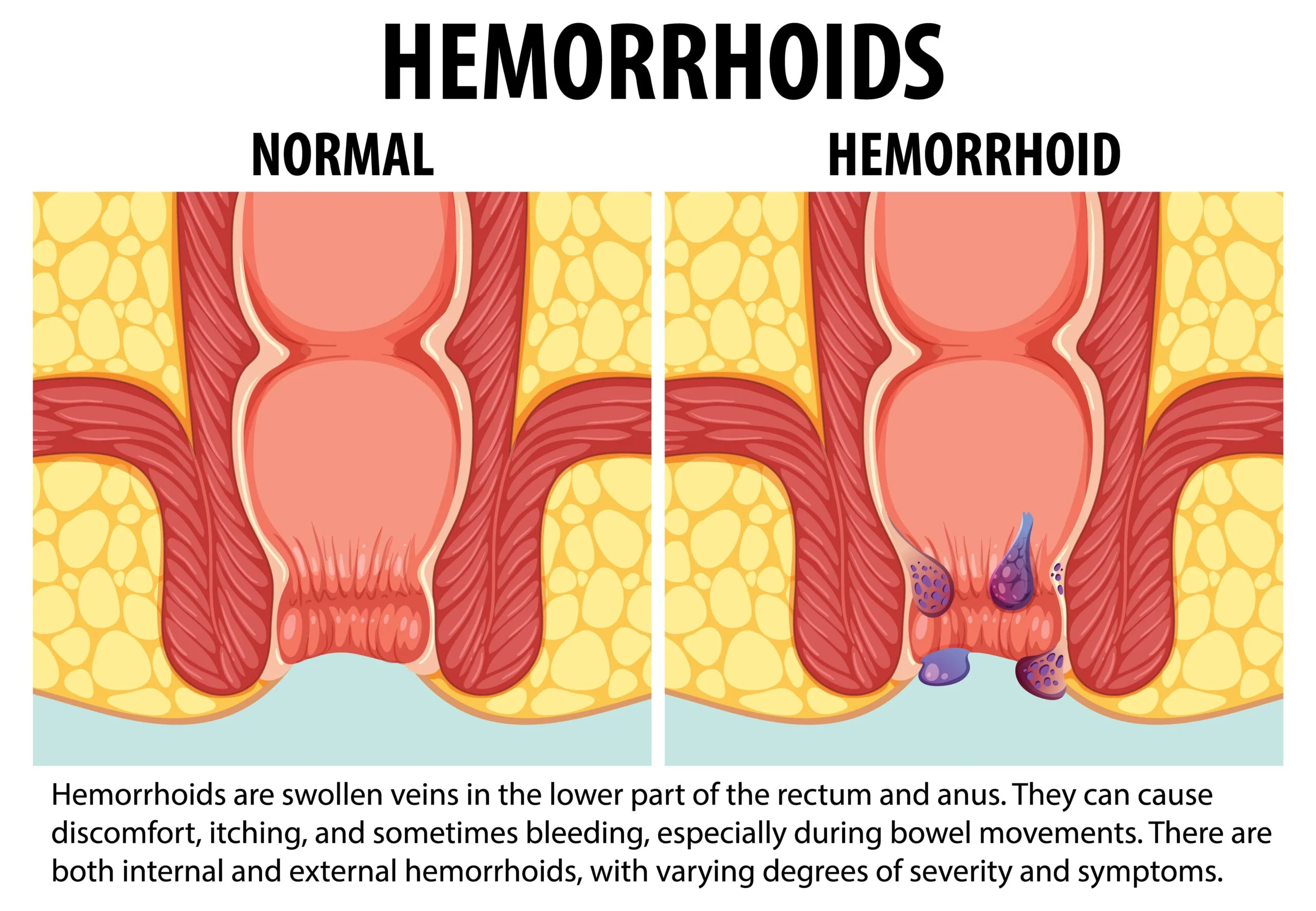 Piles and Hemorrhoids: Comprehensive Guide to Symptoms, Causes, and Treatment Options in 2024 Treatment for Piles