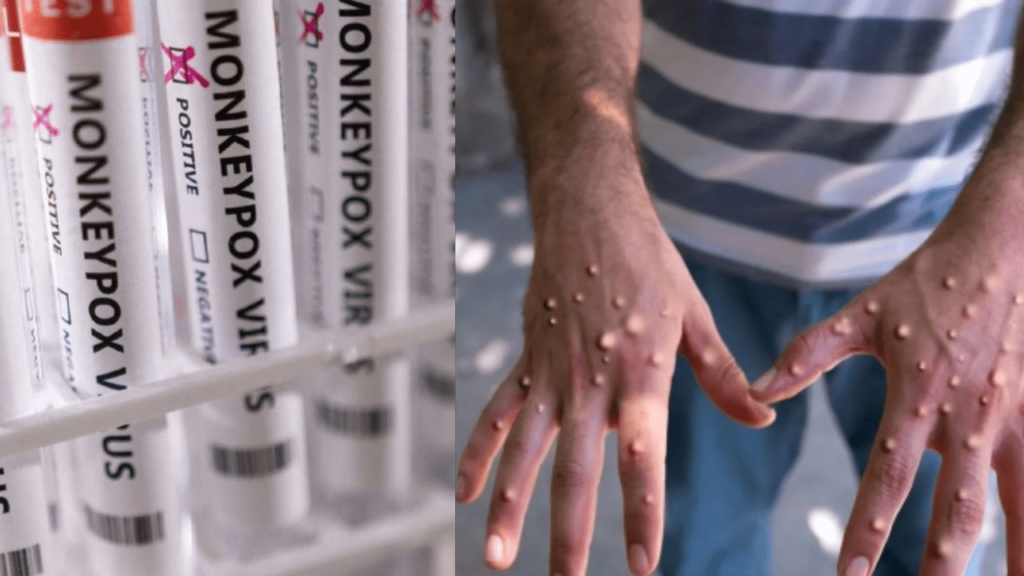 Mpox Virus Outbreak Reaches Pakistan